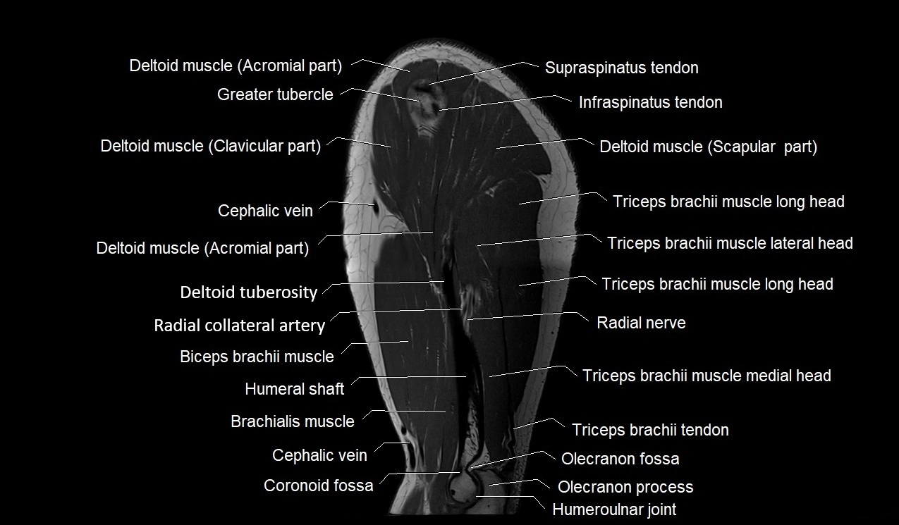 Upper arm (humerus ) saittal cross sectional anatomy 3T image 12.webp